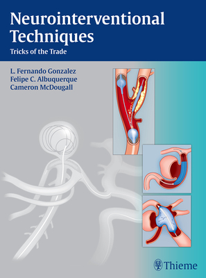 Full Download Neurointerventional Techniques: Tricks of the Trade - Fernando L. Gonzalez | PDF